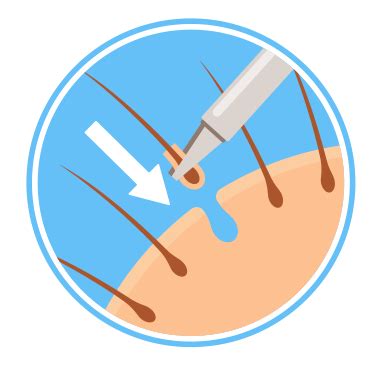 precision medical hair restoration|Hair Loss .